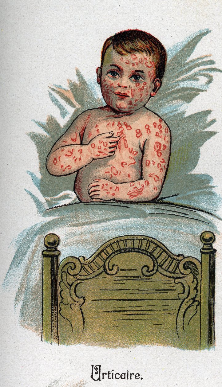 Børnesygdomme: Nældefeber. I "Den nye naturmedicin"" af F.E. Bilz. af Unknown artist