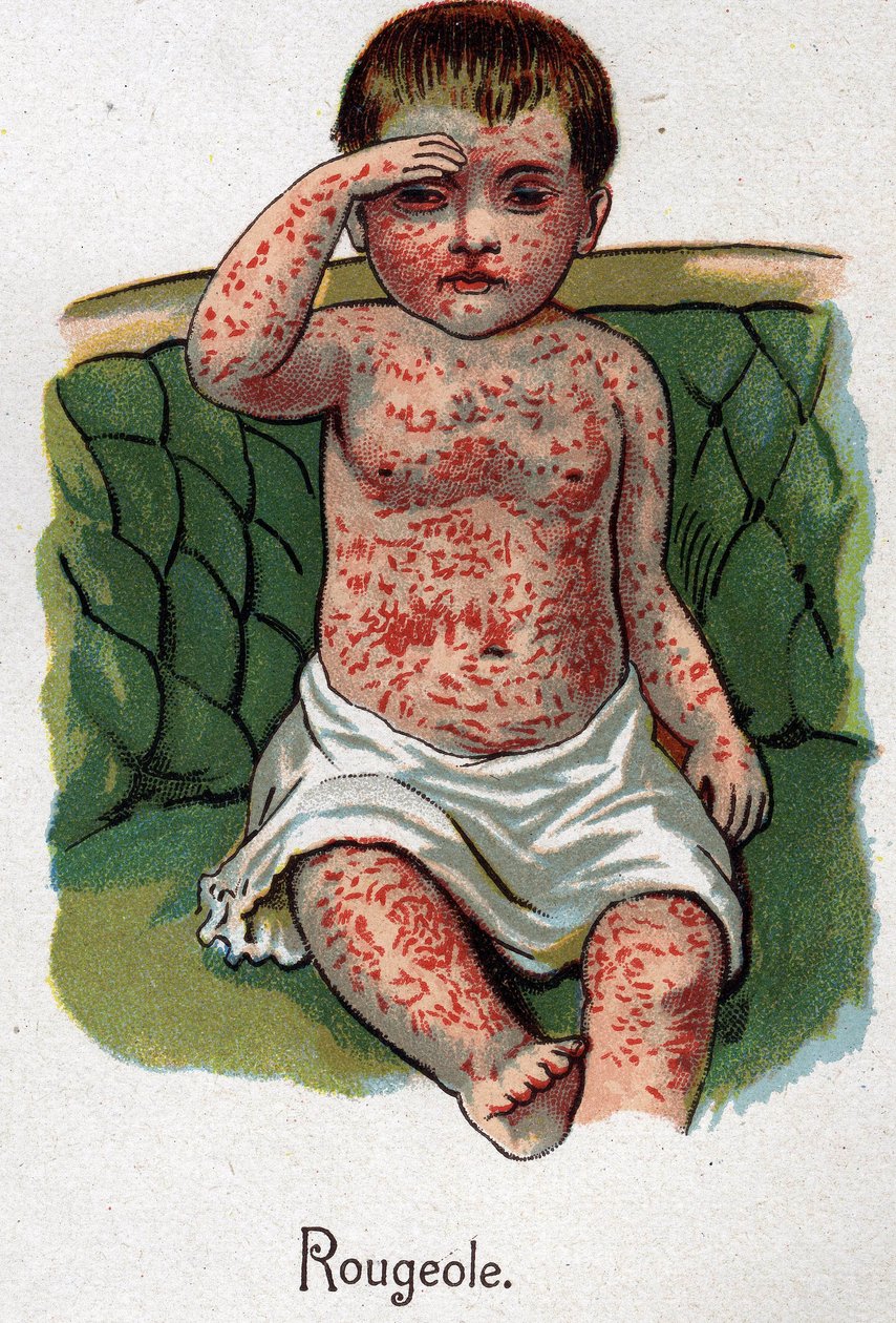 Børnesygdomme: Mæslinger. I "Den nye naturmedicin"" af F.E. Bilz. af Unknown artist
