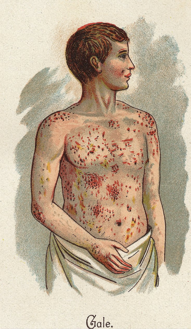 Børnesygdomme: Fnat. I "Den nye naturlige medicin"" af F.E. Bilz. af Unknown artist