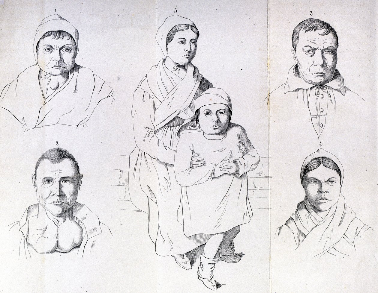 Overvejelser om årsagerne til endemisk kretinisme af Morel. af Unknown artist