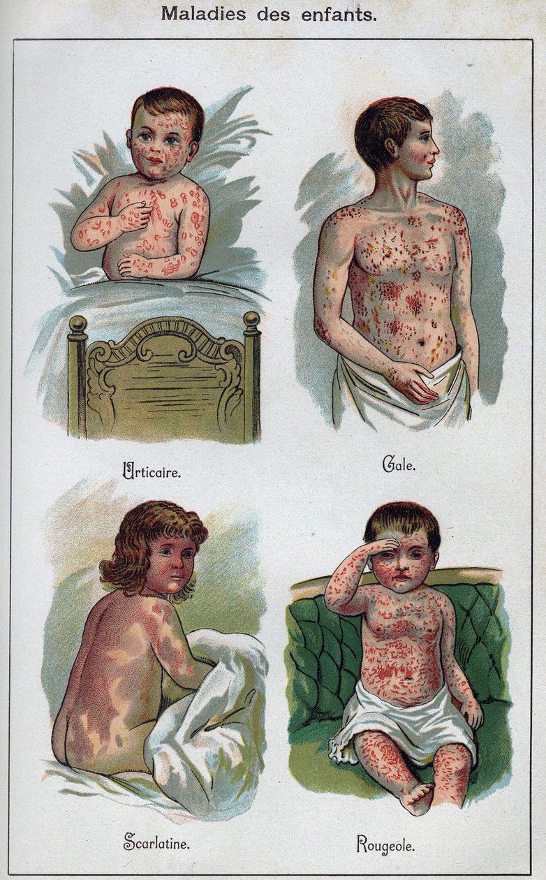 Sygdomme hos børn: Nældefeber, mæslinger, fnat, skarlagensfeber. I "Den nye naturlige medicin"" af F.E. Bilz. af Unknown artist