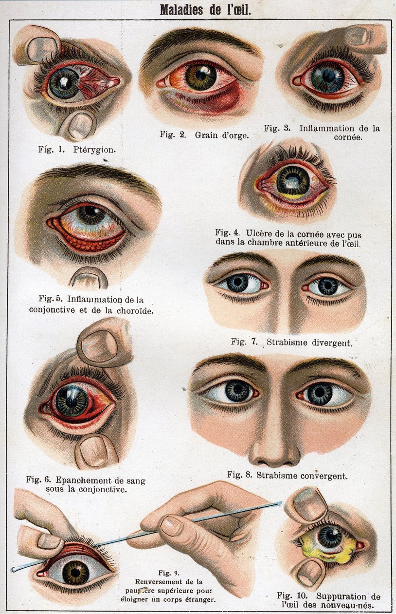 Sygdomme i øjet. "Den nye naturmedicin" af F.E. Bilz. af Unknown artist