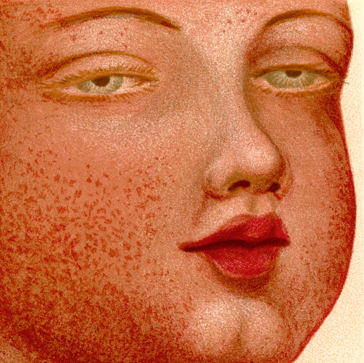 Eruptive feber: Scarlatina eller skarlagensfeber af Unknown artist