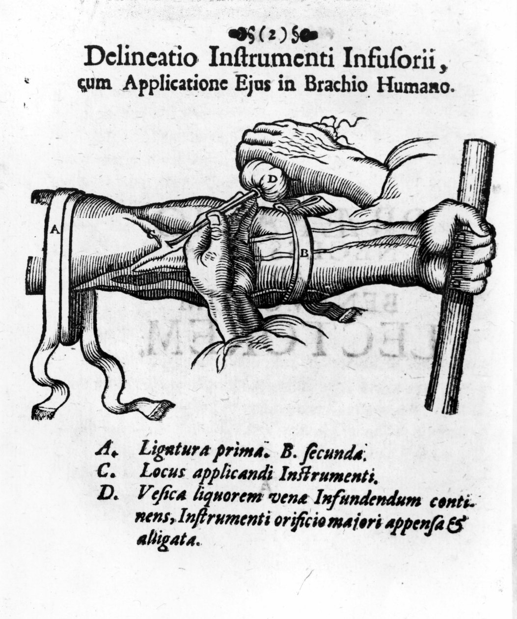 Intravenøs injektion ved hjælp af en clystery blære. af J. D. Mayor, "" Surgery Infusoria "", Kilonii 1667 af Unknown artist