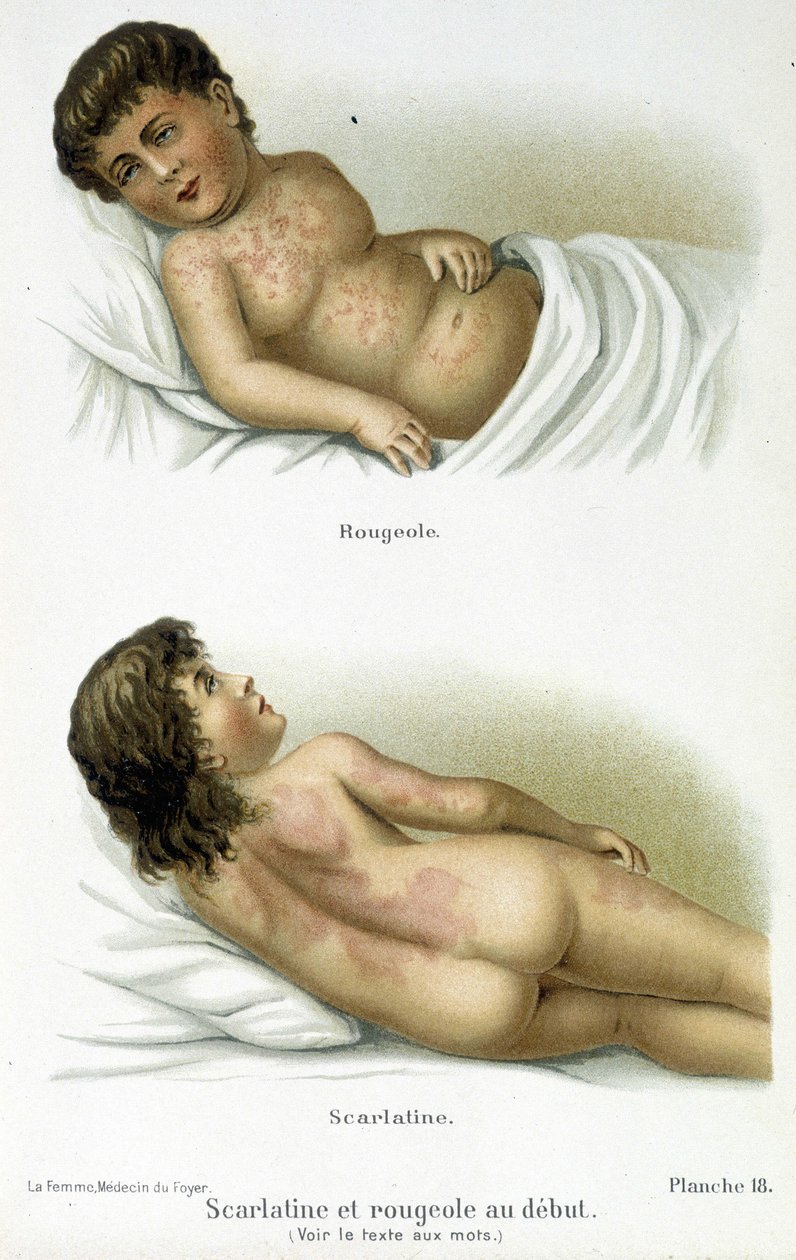 Skarlagensfeber og mæslinger - 1800-tallet af Unknown artist