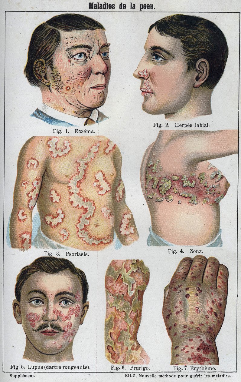 Hudsygdomme: Eksem, labial herpes, psoriasis, helvedesild, lapus (rådnende darter), prurigo, erytem." Den nye naturlige medicin”” af F.E. Bilz. af Unknown artist