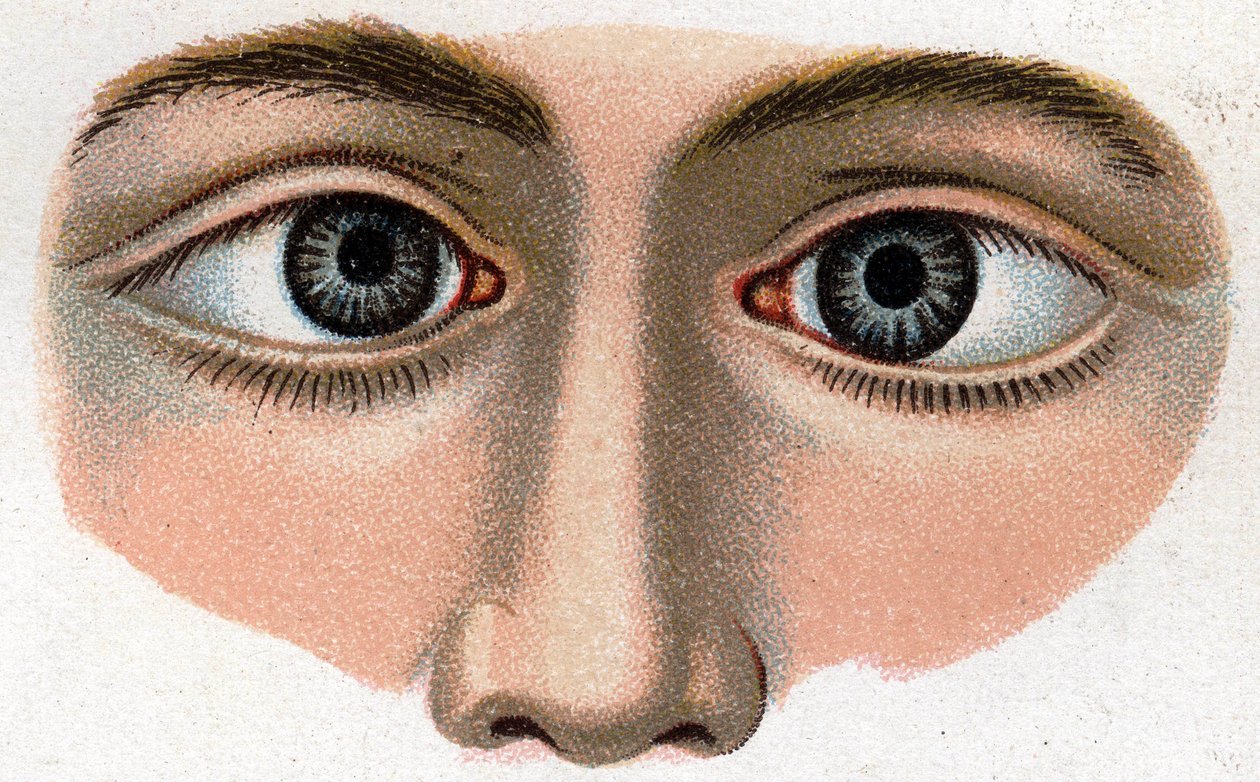 Strabismus konvergerer. "Den nye naturlige medicin" af F.E. Bilz. af Unknown artist