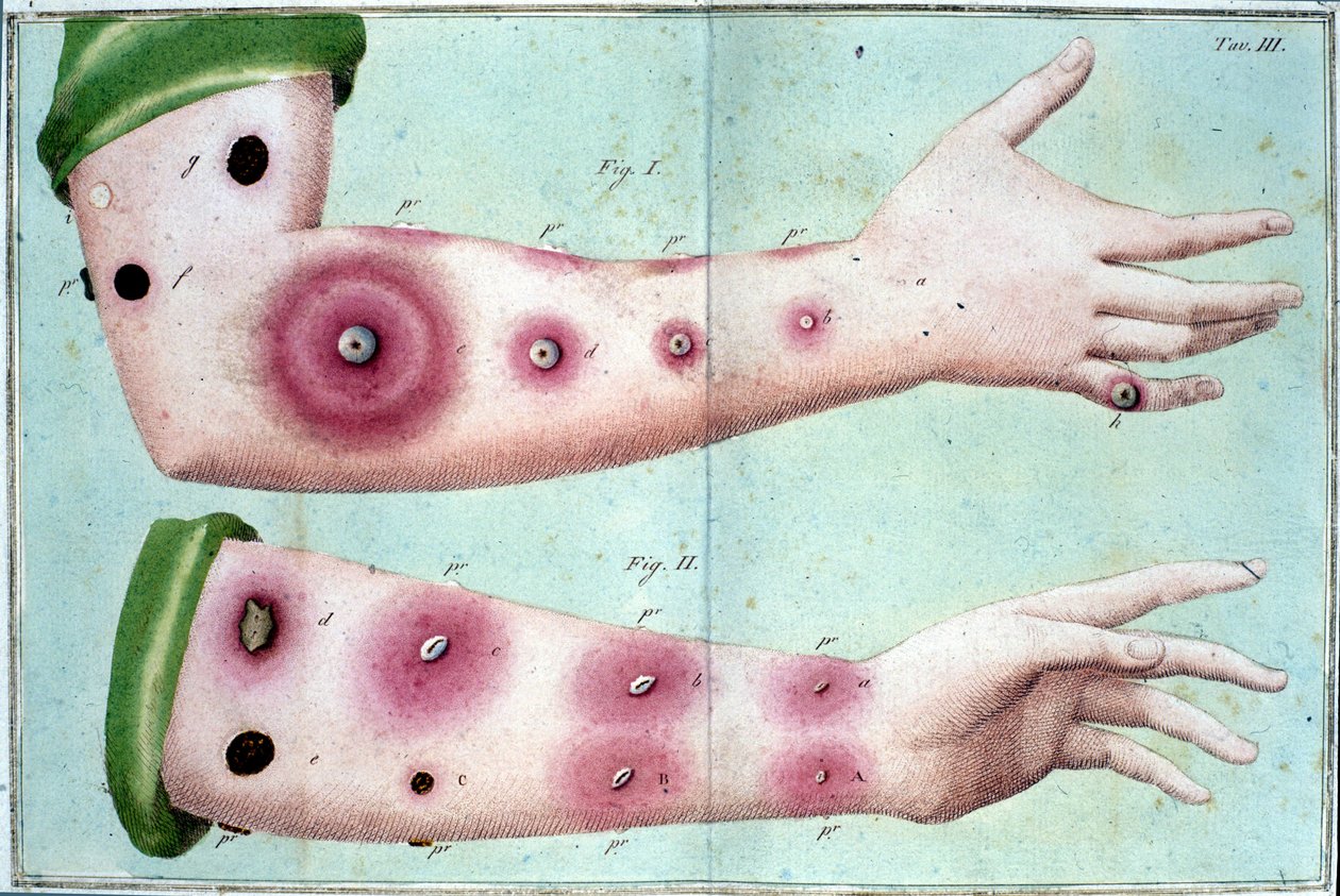 Symptomer på koppesygdom, der forårsager et udbrud af pustler på huden. Medicinsk plade fra "" Vaccination Treat" af Luigi Sacco, Milano af Unknown artist