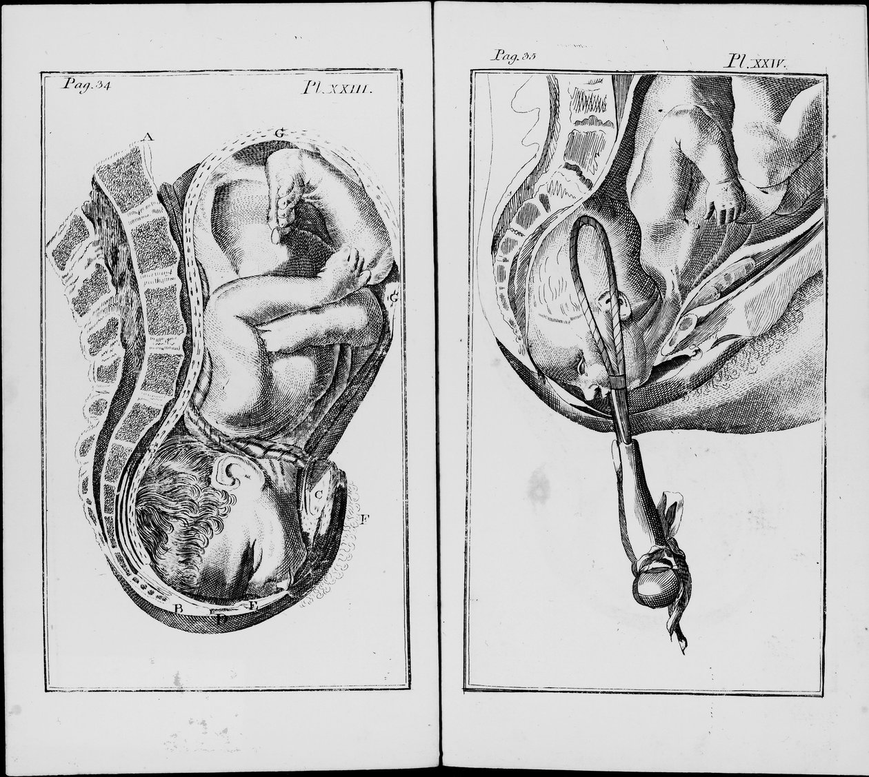 Fødsel af en baby med brug af pincet Plade fra "An abridgement of the practice of midwifery"" af William Smellie (1697-1763) af Unknown artist
