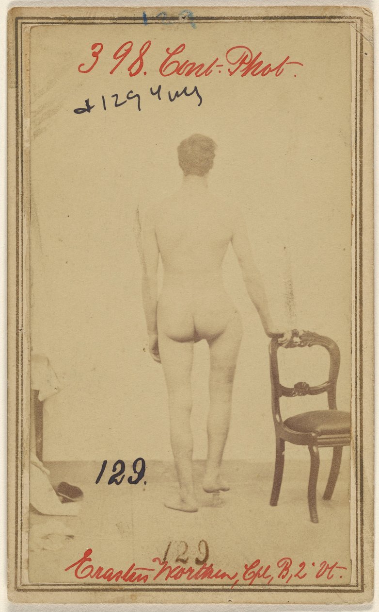 Brud på den øverste tredjedel af lårbenet. Erastus Worthen, Corp Co. B. 2nd Vermont Vols. 25 år gammel - bopæl Stockbridge VT. af Unknown artist