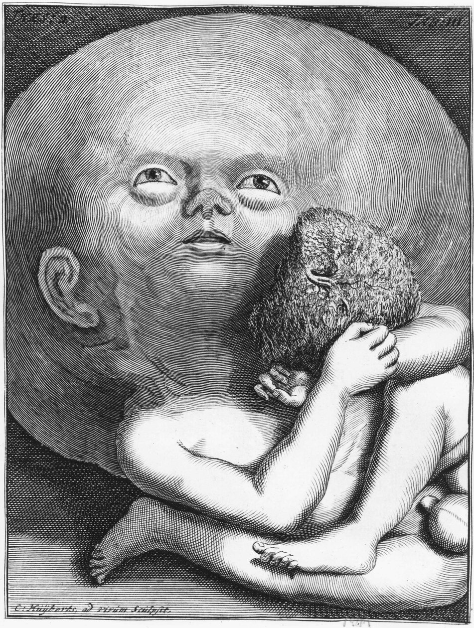 Monster: Child hydrocephalus antropologi - grav., a.n.d., slutningen af det 18. århundrede af Unknown artist