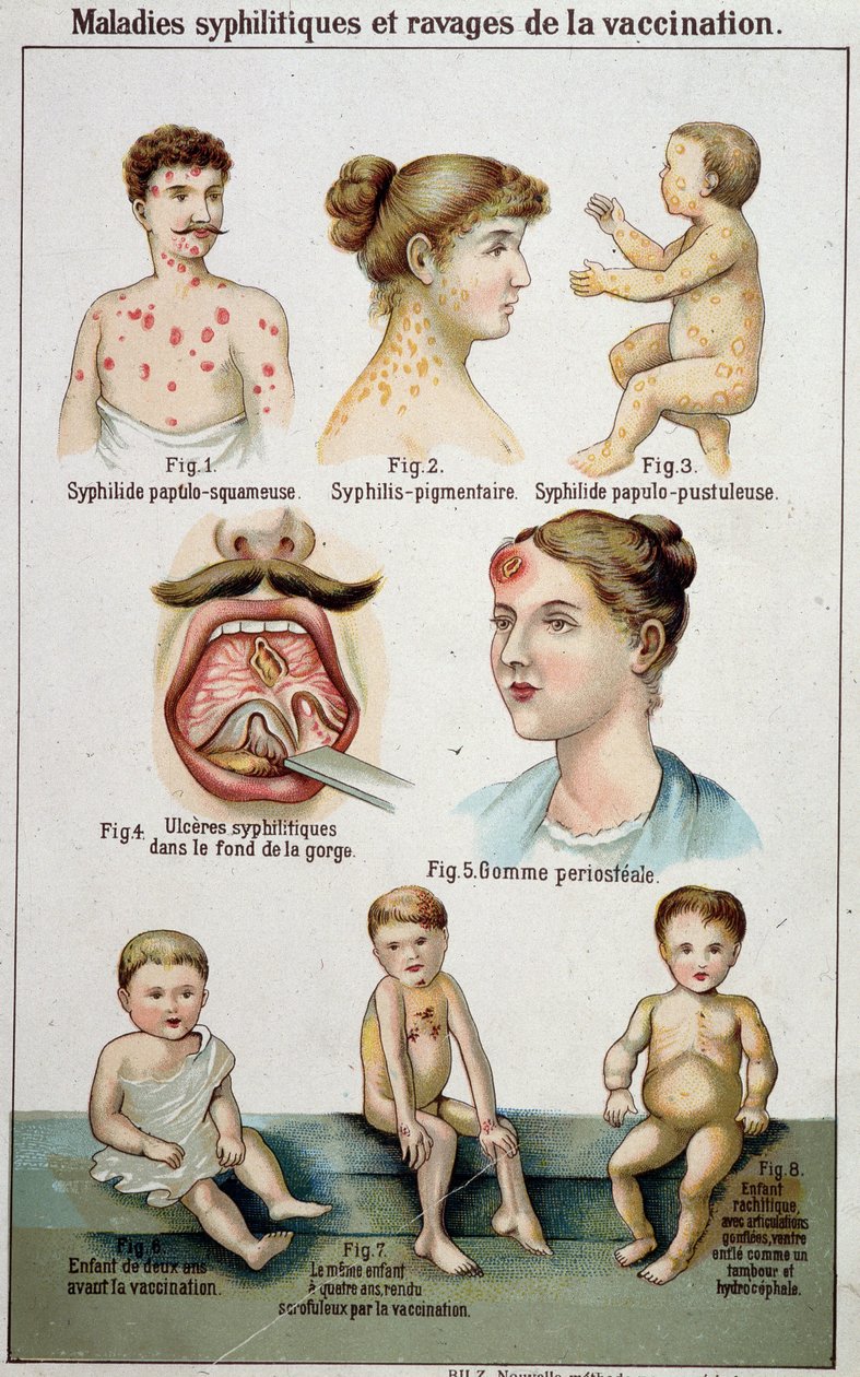 Plade, der illustrerer de forskellige sovesale af syfilitiske sygdomme og farerne ved vaccination - i Bilz naturmedicin, slutningen af det 19. århundrede. af Unknown artist