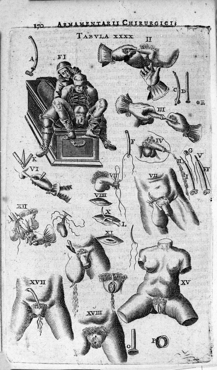 Kirurgiske indgreb på det kvindelige og mandlige køn. Indgravering i "Armamentarium Surgical" af J. Scultetus, Venedig af Unknown artist
