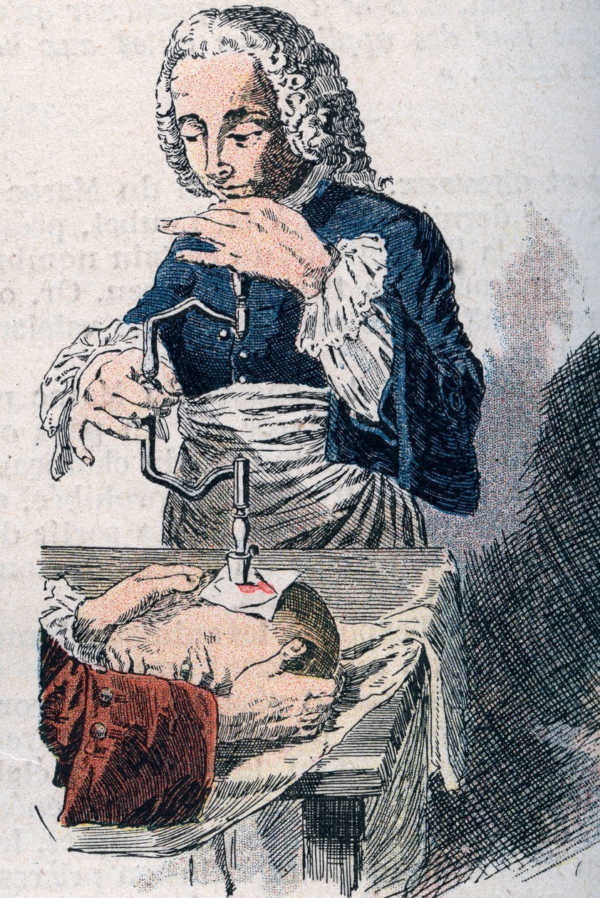 Trepanationen. 1700-tals tryk. af Unknown artist