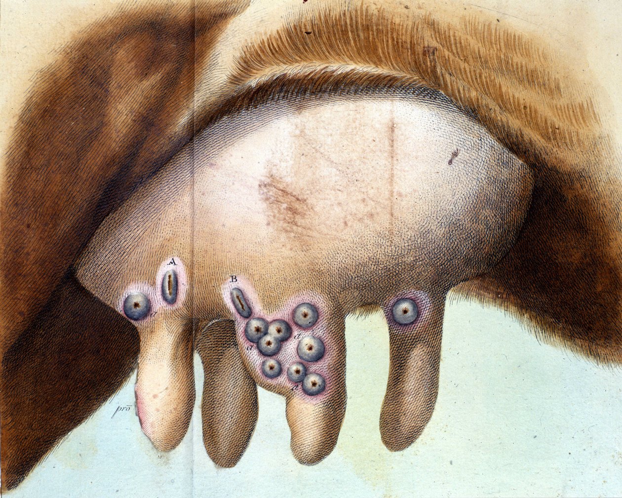 Koens bryst blev brugt til at inokulere koppevaccinen af Luigi Sacco (1769-1836) i januar 1801. Medicinsk plade fra "" Vaccination Treat" af Luigi Sacco, Milano af Unknown artist