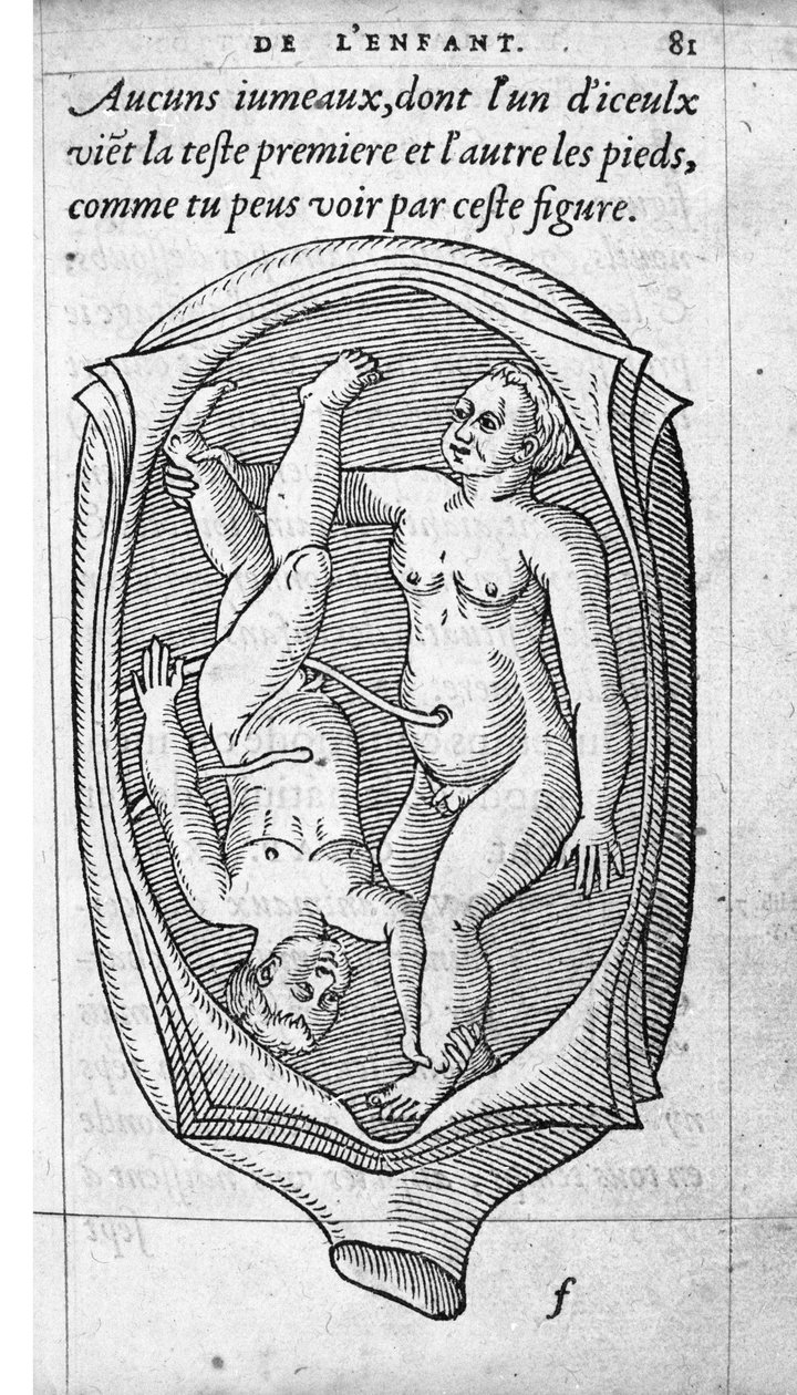 Fosterets position i livmoderen under graviditeten. Gravering fra "" De la generation des enfants"" af den franske læge og kirurg Ambroise Pare (1509-1590) 1500-tallet af Unknown artist
