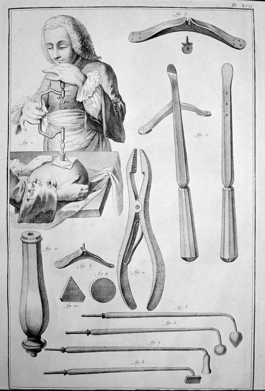 Trepanering af kraniet, forskellige instrumenter (gravering af Unknown artist