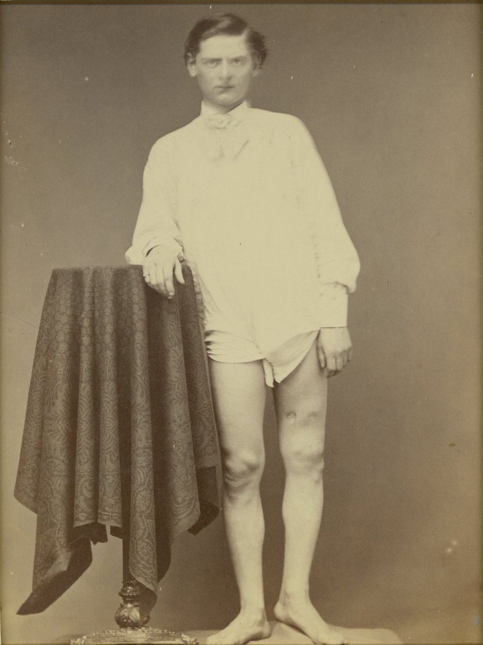 Såret borgerkrigssoldat (Privat Charles Westerfield, Army Medical Museum-eksemplar nr. 4278), april 1865, 1865 (albumin-tryk) af William Abraham Bell