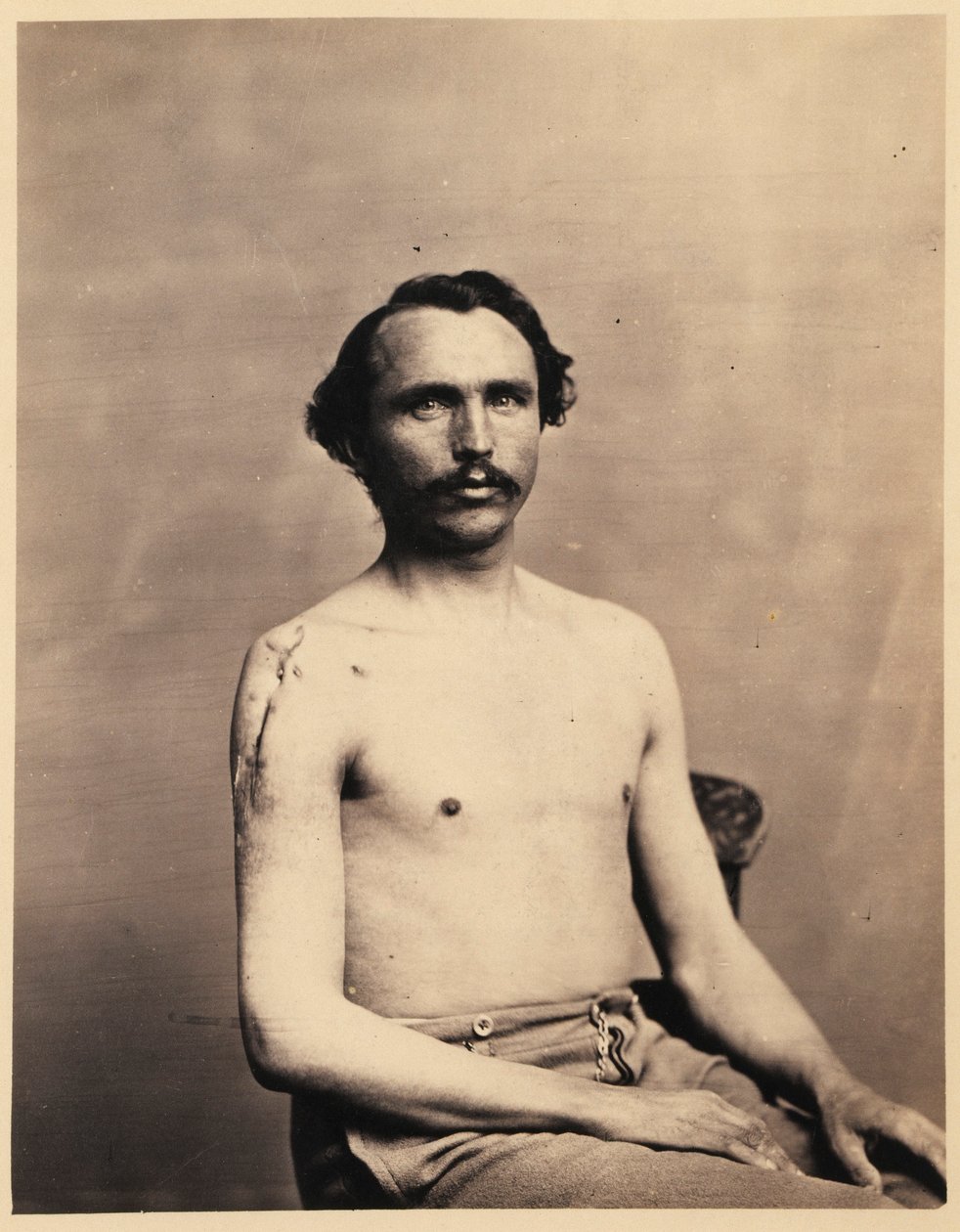Menig Adolph Zirsse, vellykket mellemliggende excision af hovedet og to en halv tomme af skaftet på højre humerus, fra det fotografiske katalog over den kirurgiske afdeling af William Bell
