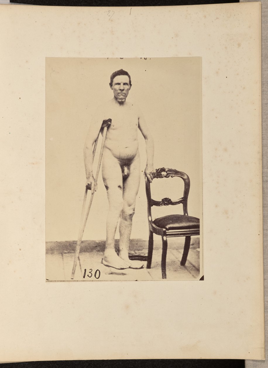 Konsolideret skudfraktur i den midterste tredjedel af højre lårbensknogle af William H. Bell