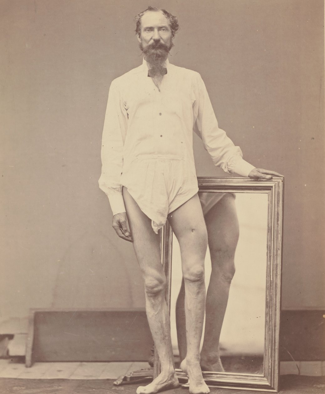 Skudsår af midterste tredjedel af venstre lårben, 1865-67. af William H. Bell