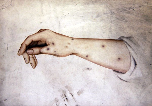 Studie af en underarm med hudtilstand, ca. 1850 (akvarel på papir) af William Lover