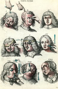Kirurgi i det 18. århundrede: Trepanation og operation af øjet og ansigtet. Indgravering i "Institutions chirurgicale" af Lorenz Heister af Anonymous Anonymous