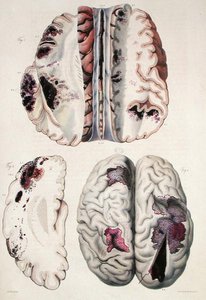 Kapillær apopleksi, fra "Anatomie Pathologique du Corps Humain" af Jean Cruveilhier (1791-1874) 1828-42 (farvestik)