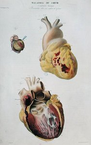 Plade, der viser hjertesygdomme. Spontan brud på hjertet af en 86-årig kvinde (fig. 1) og perikarditis hos en seks dage gammel baby (fig. 2), fra 