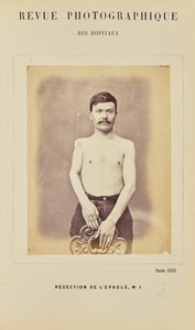 Skulderresektion, nummer 1 af Arthur de Montmeja