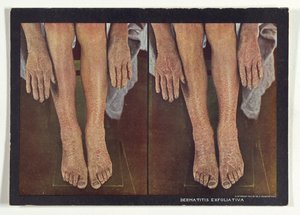 Dermatitis Exfoliativa af Dr. Selden I. Rainforth