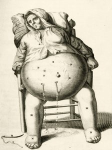 Dræning af væsker fra en byld af Frederik Dekkers, 1694 af Dutch School