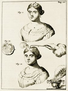 Behandling af en epilepsipatient, fra Øvelser i Lægekunst af Frederik Dekkers, 1694 af Dutch School
