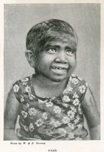 Krao, The Missing Link, udstillet på Aquarium, Westminster, London, i 1887 af English Photographer
