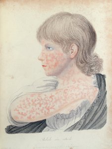 Tyske mæslinger, illustration til en bog af Robert Willan (1757-1812), 1808 (farvegravering) af English School