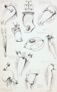 Metoder til at arrestere blødning, ca. 1890 af English School