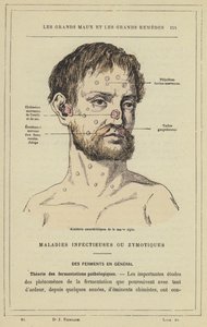 Karakteristiske strøg af akut snot (farve litho) af French School