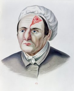 Efter en hudtransplantationsoperation, fra Selecta Praxis Medico-Chirurgica af Alexander Auvert, Paris, 1856 af French School