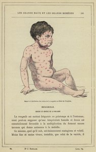 Udseende og fordeling af mæslingepletter ved begyndelsen af ​​udbruddet (farve litho) af French School