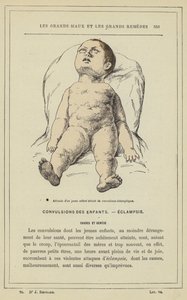 Holdning hos et lille barn med eklamptiske kramper (farve litho) af French School
