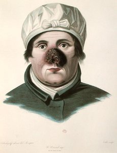 Før en hudtransplantationsoperation, fra 