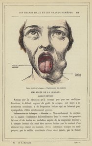 Sårkræft i tungen, Degeneration af lymfeknuder (farve litho) af French School