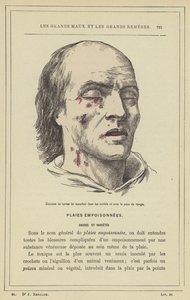 Udklækning af fluelarver i hulrummene og under huden i ansigtet (farve litho) af French School