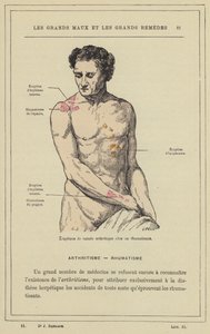 Udbrud af arthritisk karakter hos en gigtpatient (farve litho) af French School