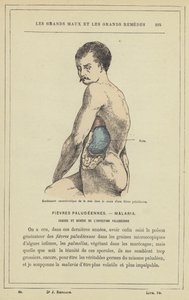 Karakteristisk hævelse af milten i løbet af malariafeber (farve litho) af French School