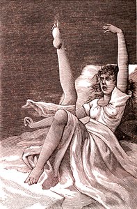 Hysteri, et ekstremt mentalt fænomen, psykoser og psykoneurose.1887 (gravering) af French School