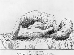 Hysteri og somnambulisme, fra Les Maladies Epidemiques de lEsprit af Paul Regnard (1850-1927) 1884 af French School
