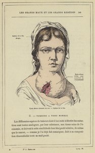 Cloisonne serøs cyste i halsen, Lipoma i hovedet (farve litho) af French School