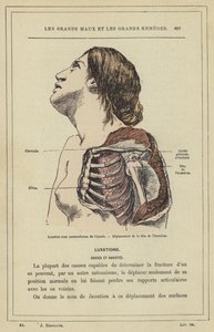 Subcoracoid dislokation af skulderen, forskydning af hovedet på humerus (farve litho) af French School