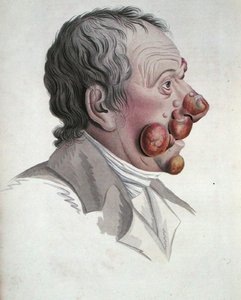 Mycosis Fongoide, fra en bog af Baron Jean Louis Alibert (1768-1837) 1838 (farvet gravering) af French School